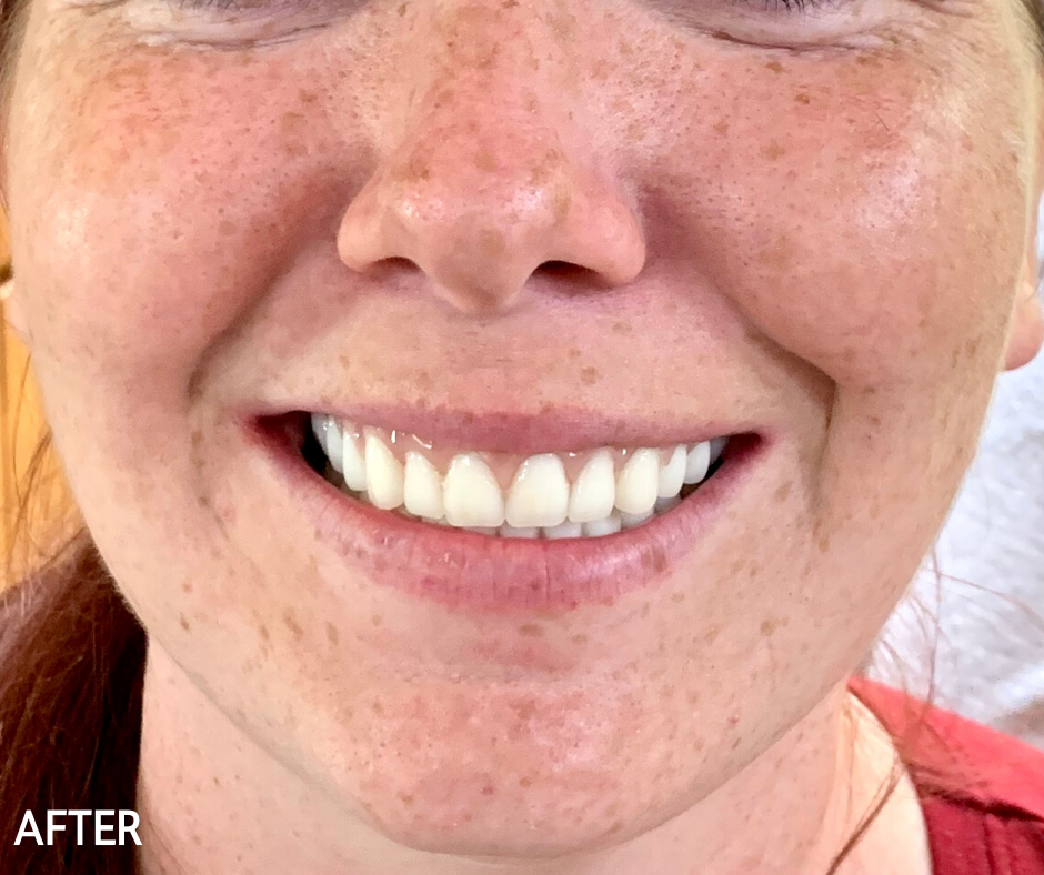 Snap in Dentures Custom Dental of Atoka Atoka OK